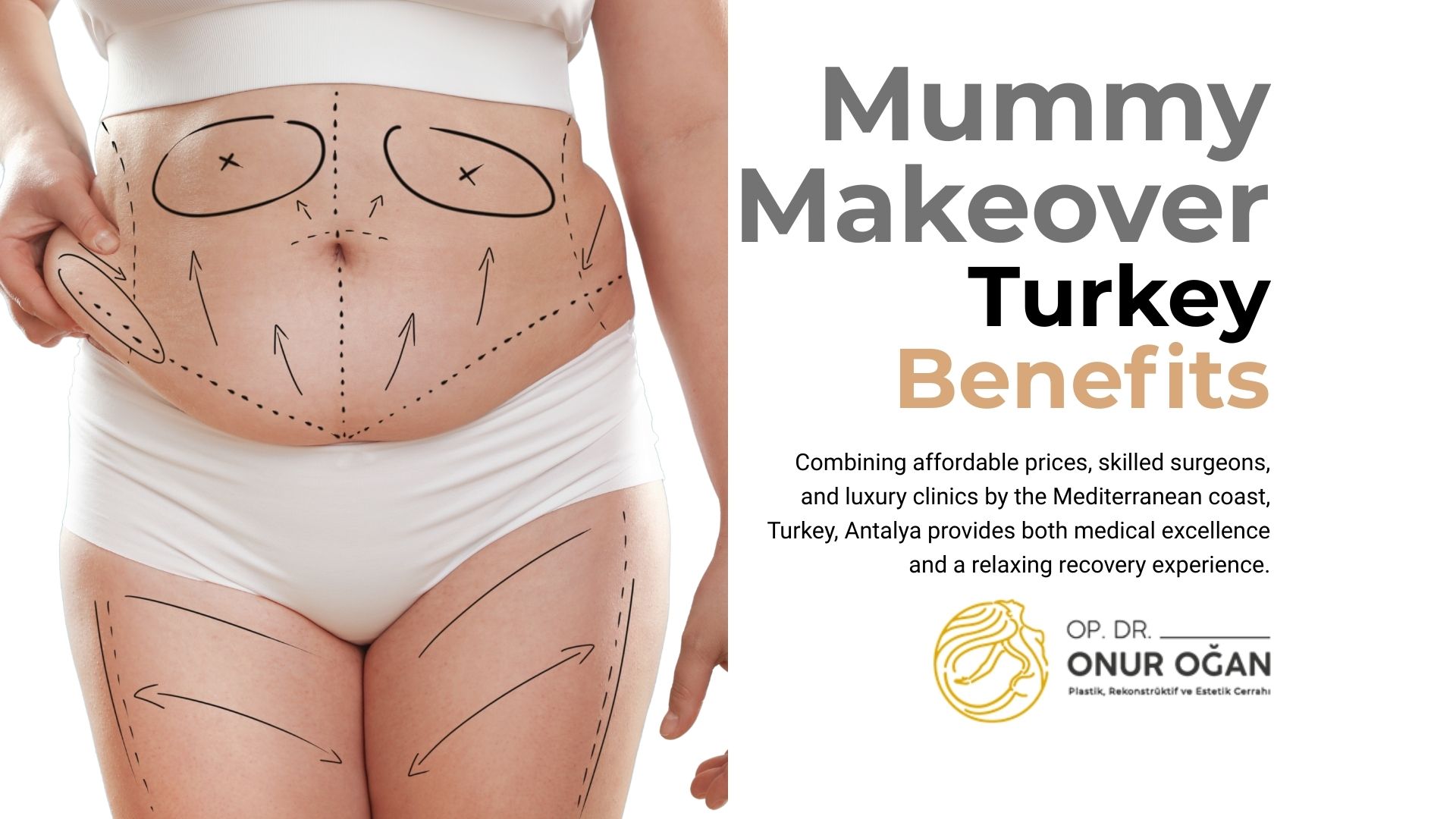 Benefits of a Mommy Makeover in Turkey, Antalya 