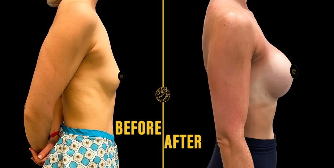 breast-augmentation-before-after-1 in Turkey, Antalya 