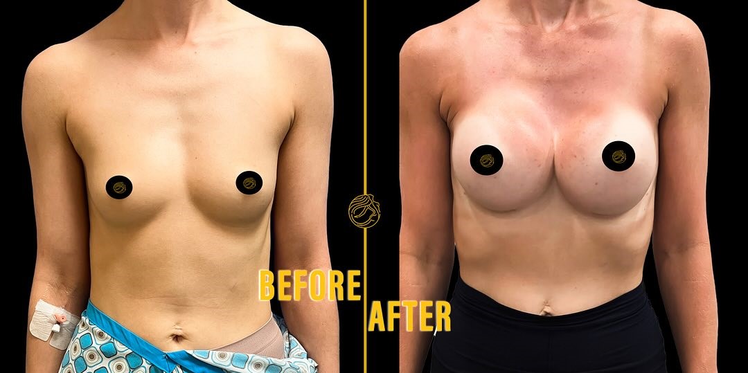 breast-augmentation-before-after-2 in Turkey, Antalya 