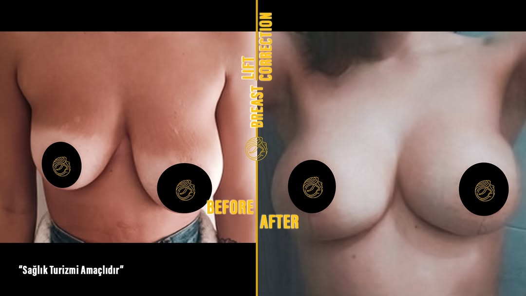 breast-lift-before-afters in Turkey, Antalya 