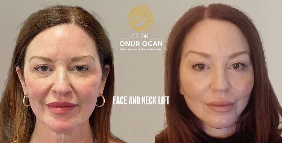 Deep Plane Face & Deep Plane Neck Lift 