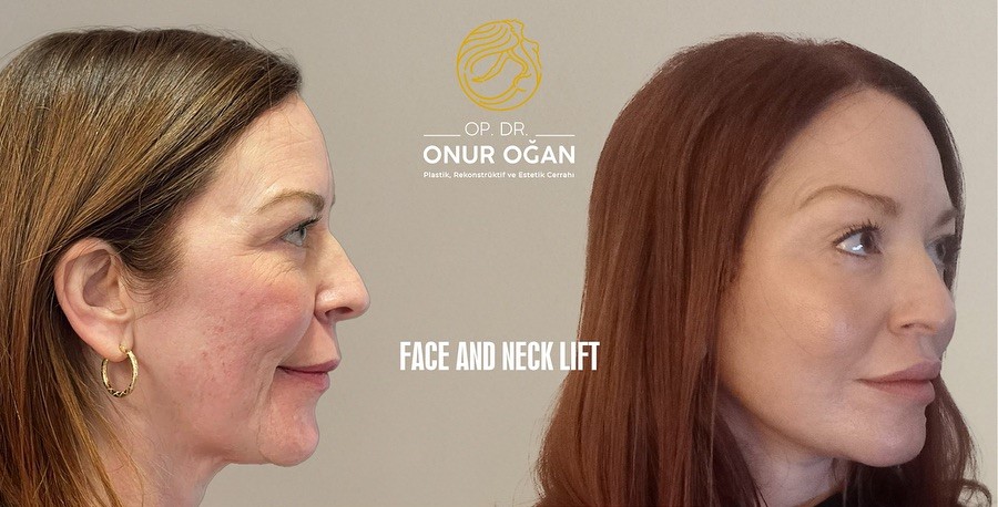 Deep Plane Face & Deep Plane Neck Lift 