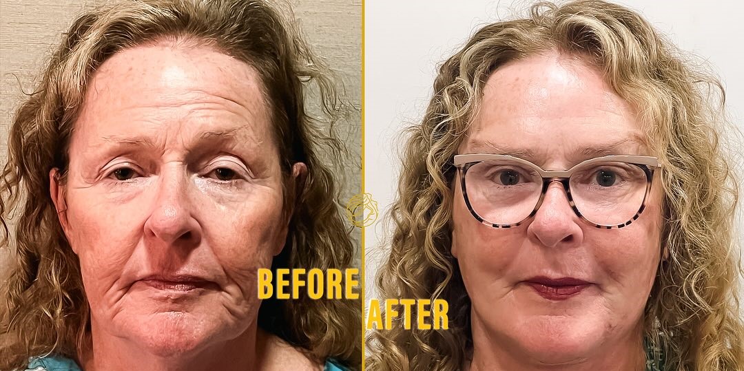Deep Plane Face & Deep Plane Neck Lift 