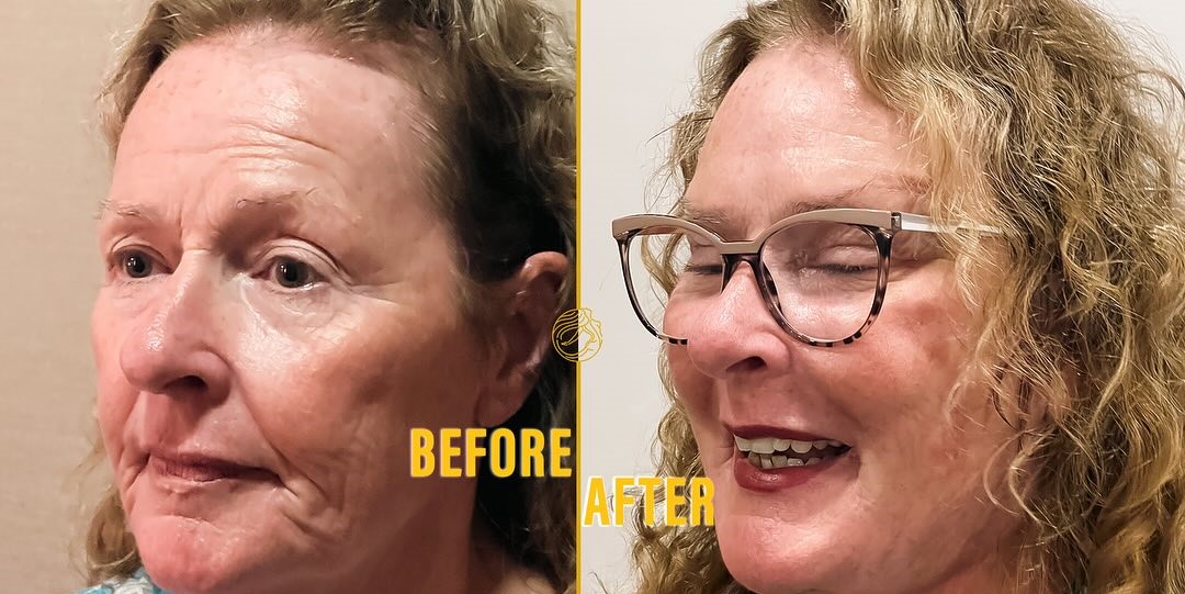Deep Plane Face & Deep Plane Neck Lift 