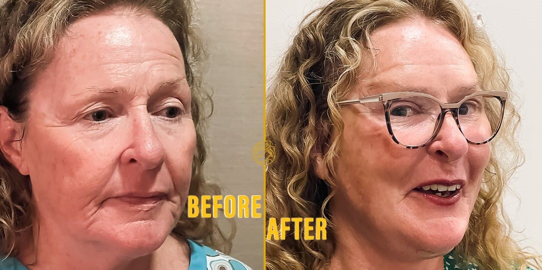 Deep Plane Face & Deep Plane Neck Lift 