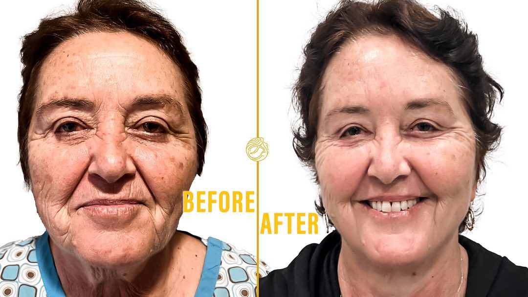 Deep Plane Face & Deep Plane Neck Lift 
