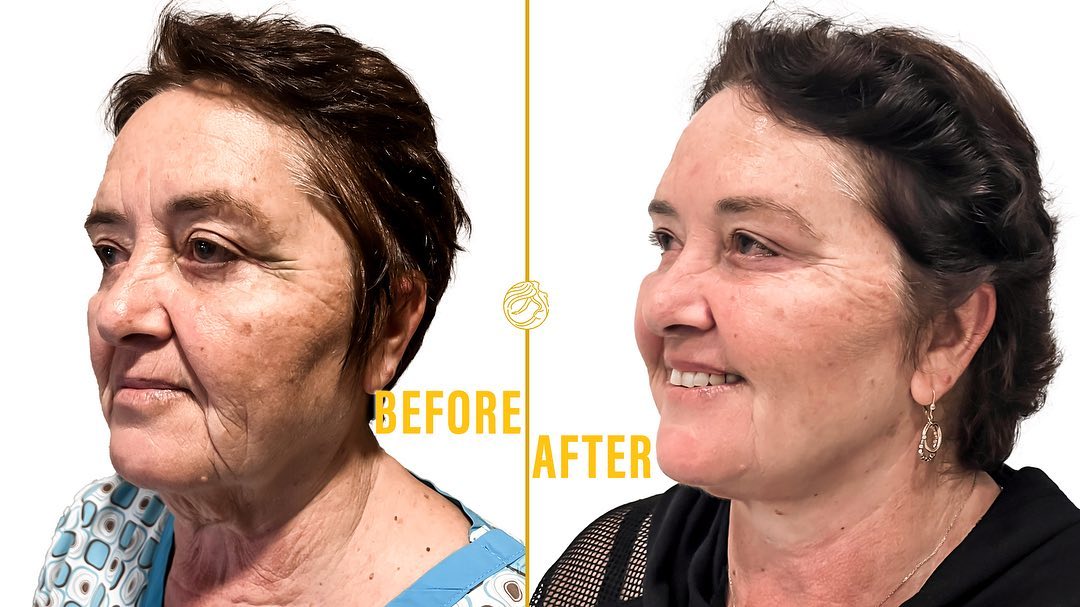Deep Plane Face & Deep Plane Neck Lift 