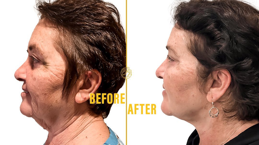 Deep Plane Face & Deep Plane Neck Lift 