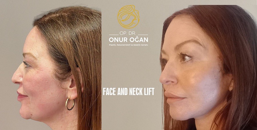 Deep Plane Face & Deep Plane Neck Lift 
