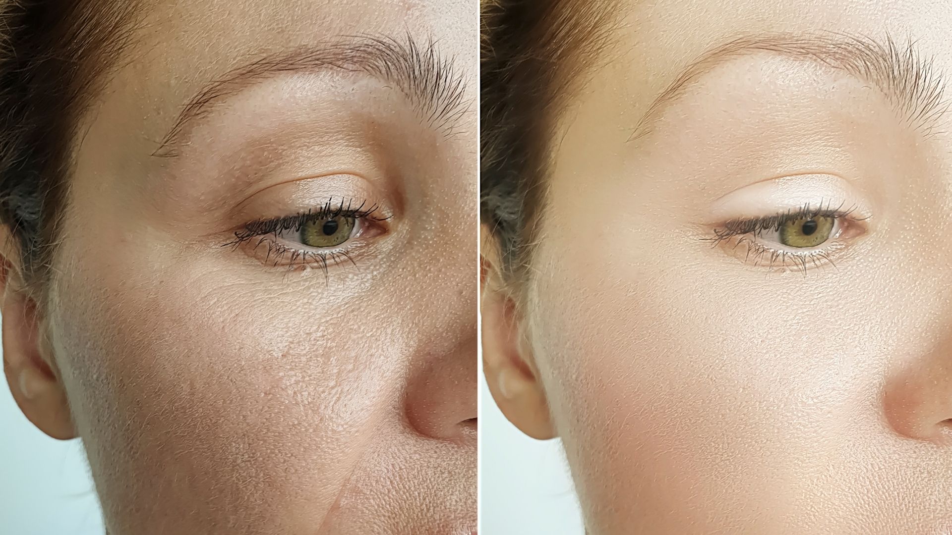 endoscopic-brow-lift-1 