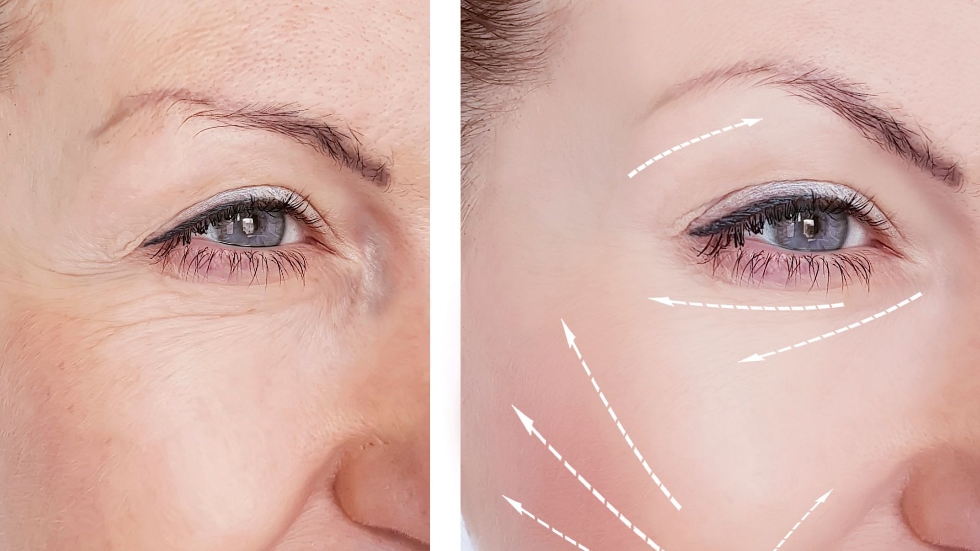 endoscopic-brow-lift-2 