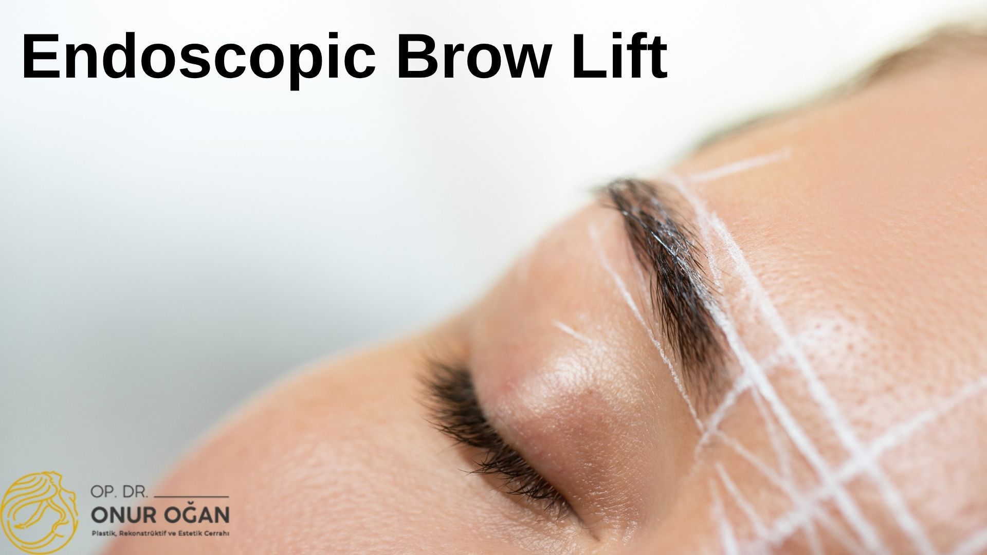 Endoscopic Brow Lift in Turkey, Antalya