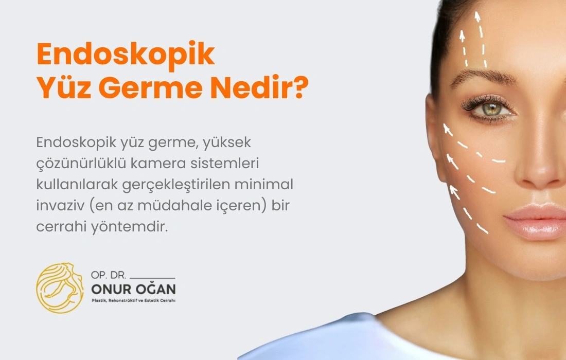 Endoskopik Yüz Germe Nedir? Fiyatları Antalya, Endoskopik Orta Yüz Germe