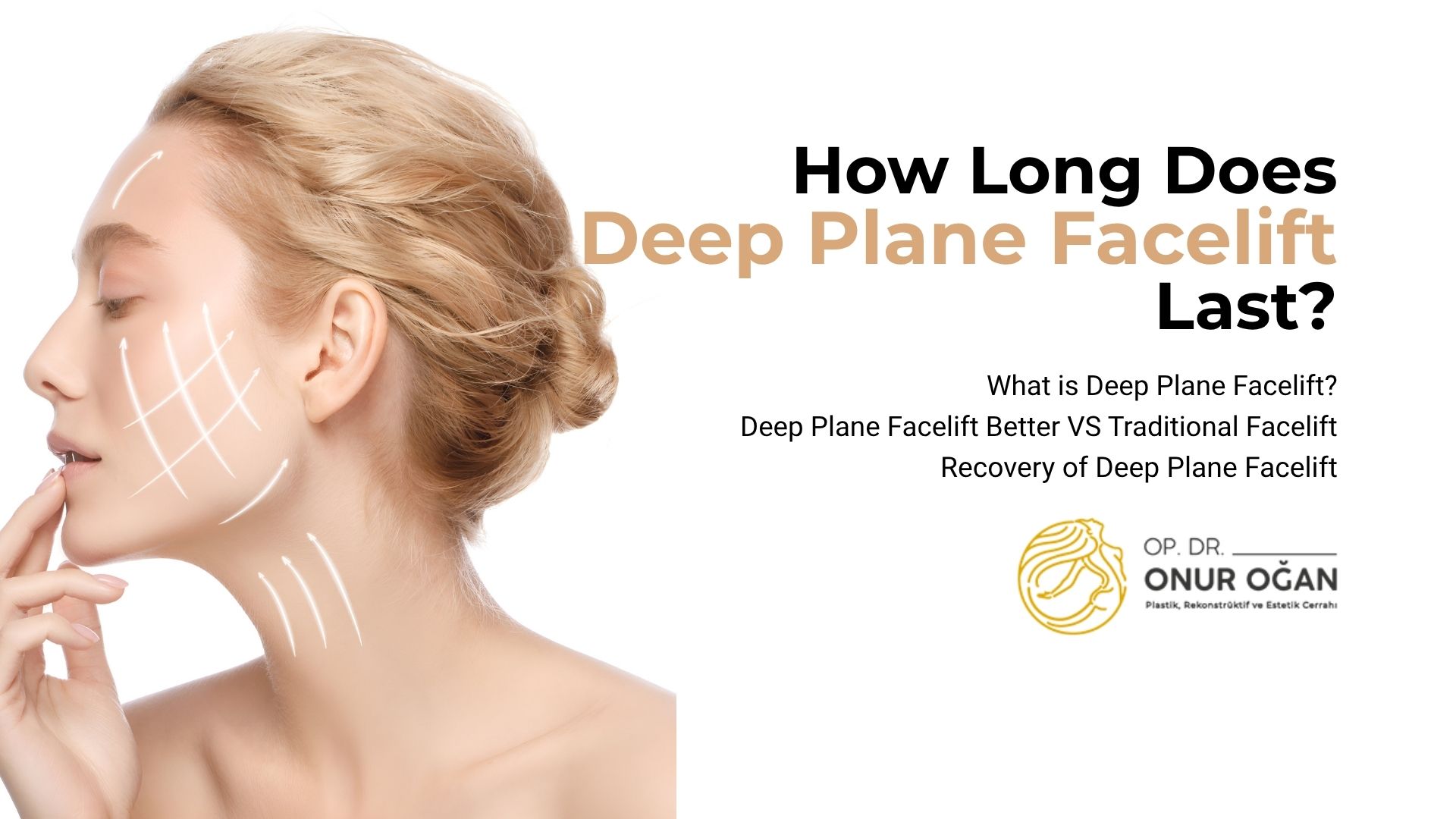 How long does a deep plane facelift last? 