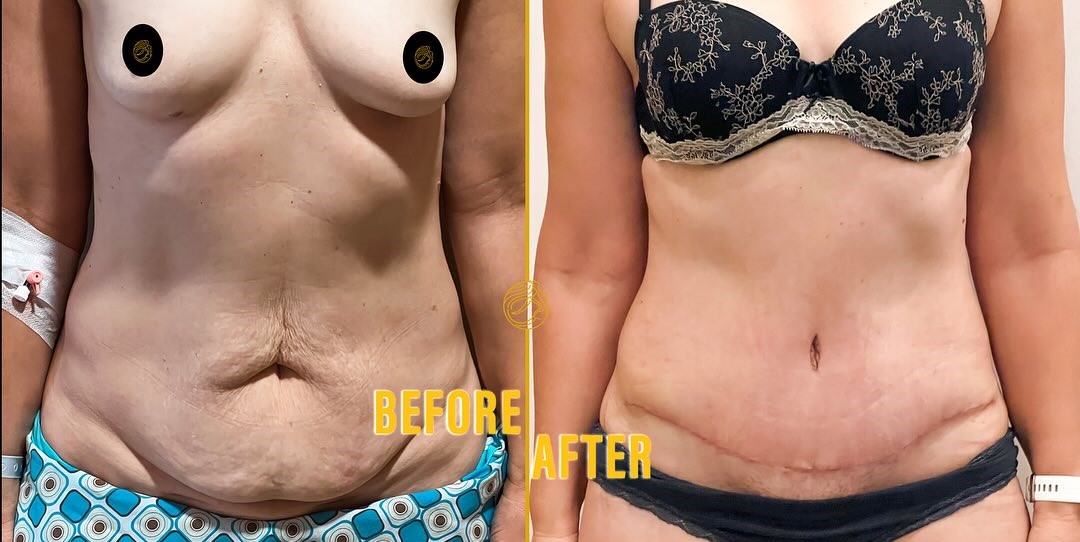 mini-tummy-tuck-before-after-1