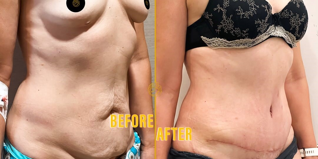 mini-tummy-tuck-before-after-2