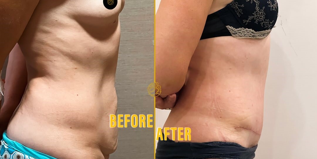 mini-tummy-tuck-before-after-3