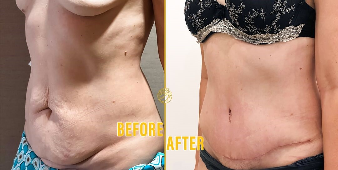 mini-tummy-tuck-before-after-4
