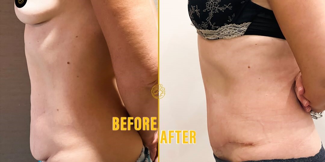 mini-tummy-tuck-before-after-5