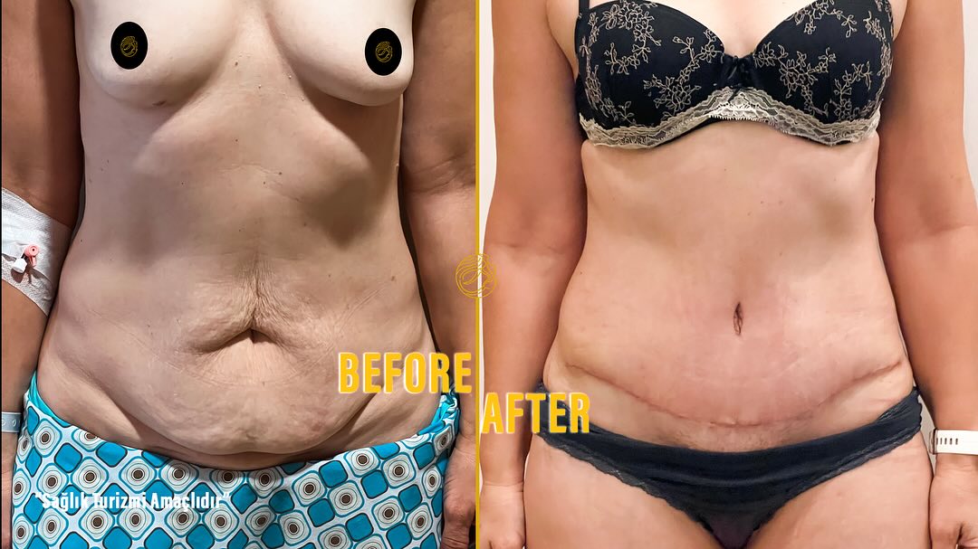 mommy-makeover-before-and-after-17