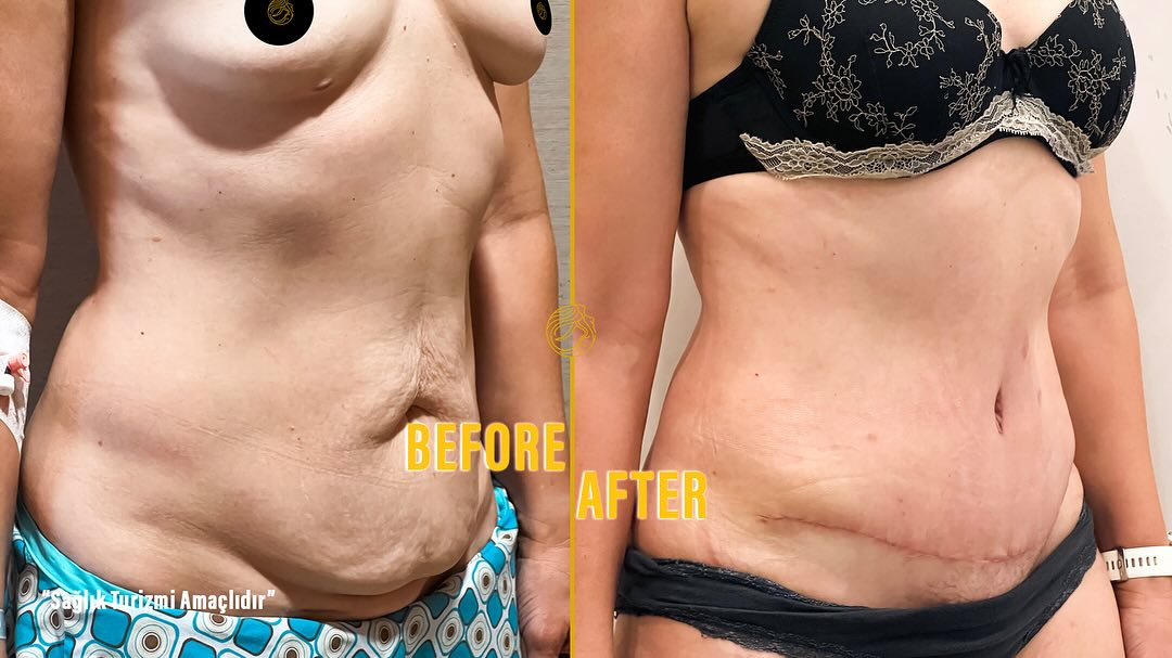 mommy-makeover-before-and-after-18