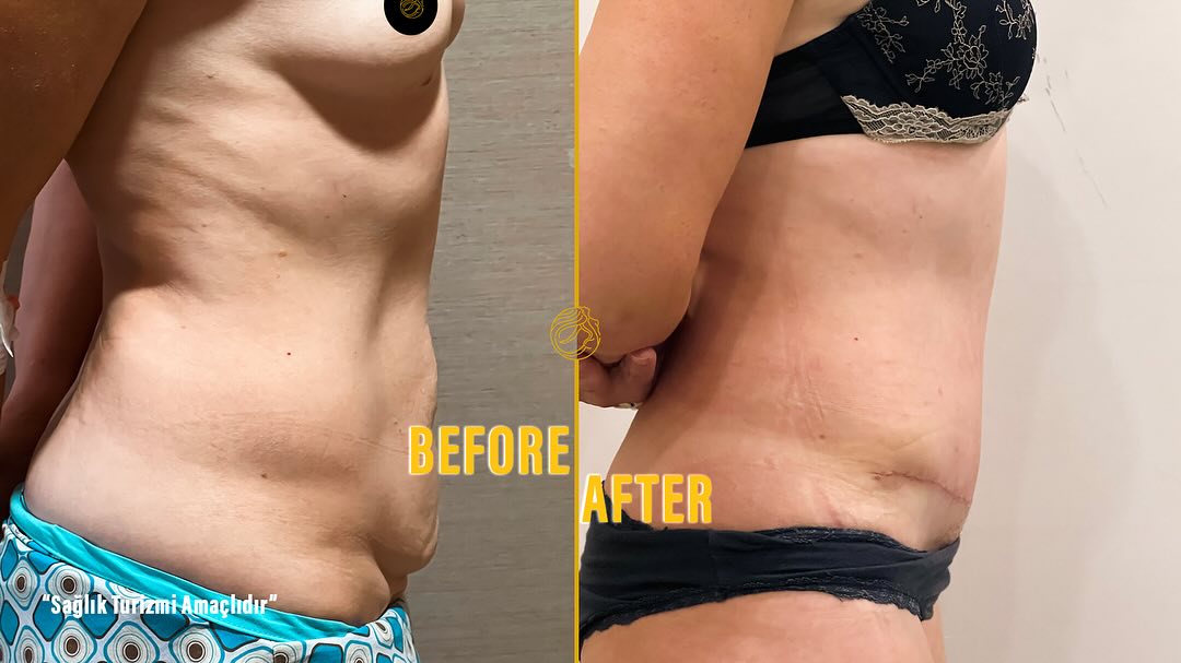 mommy-makeover-before-and-after-19