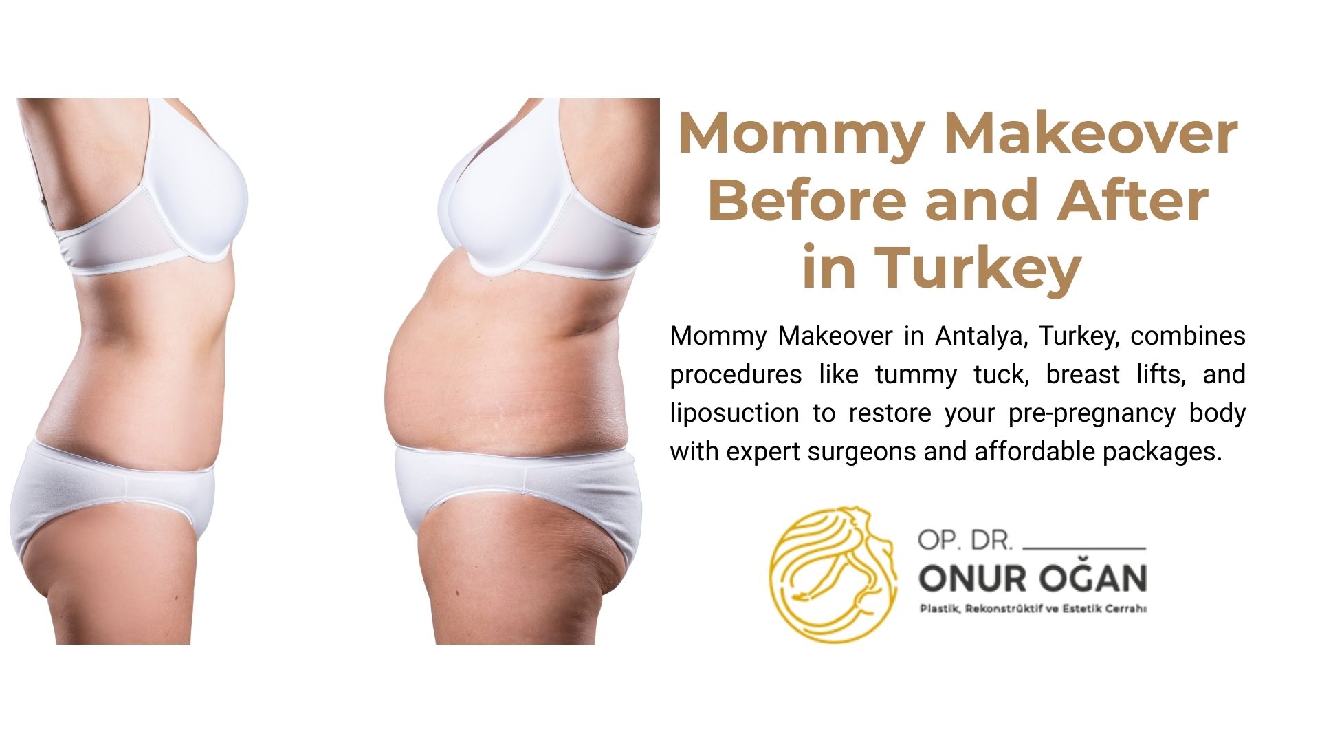 mommy-makeover-before-and-after-turkey