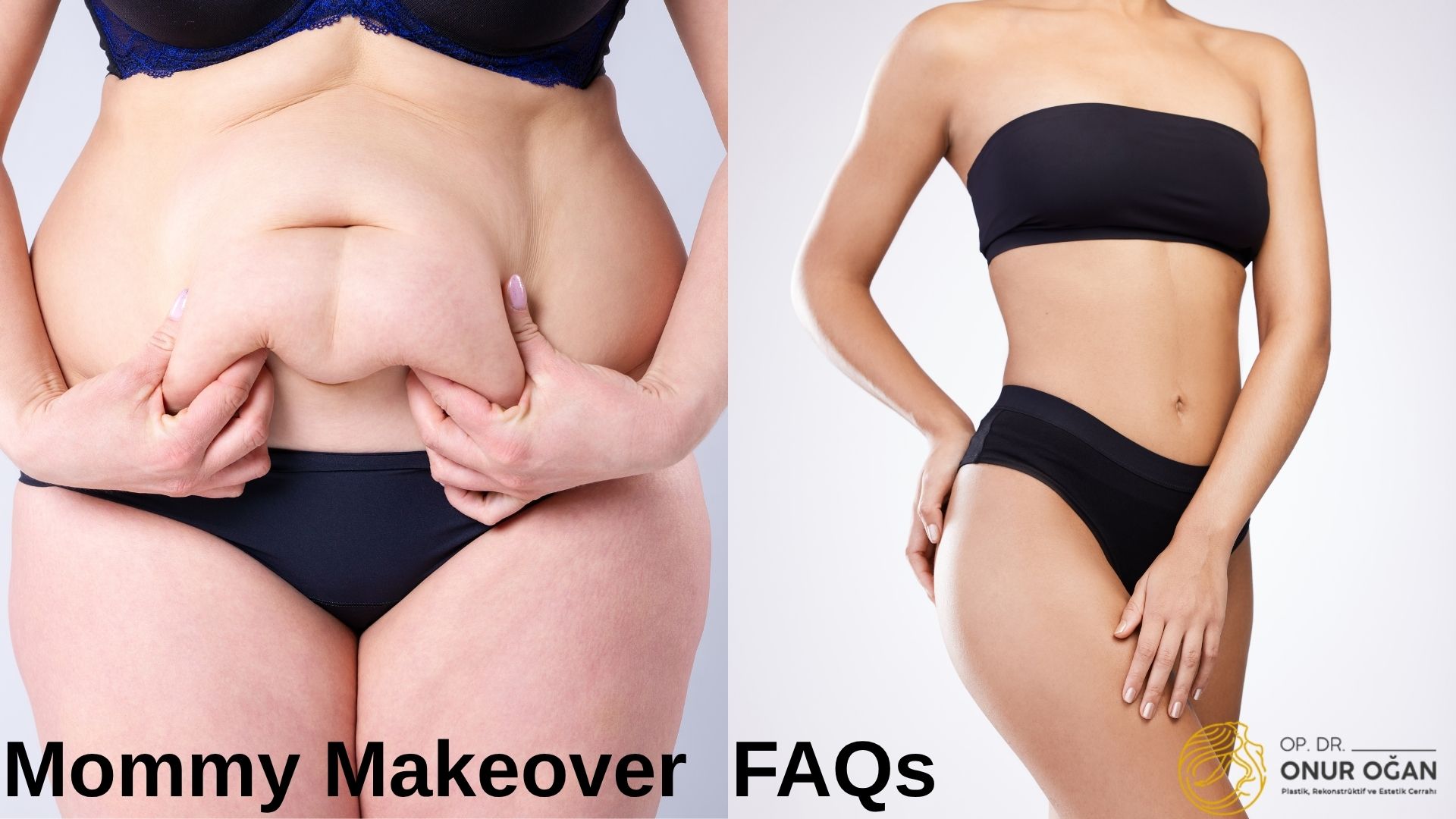 Mommy Makeover Frequently Asked Questions in Turkey, Antalya 