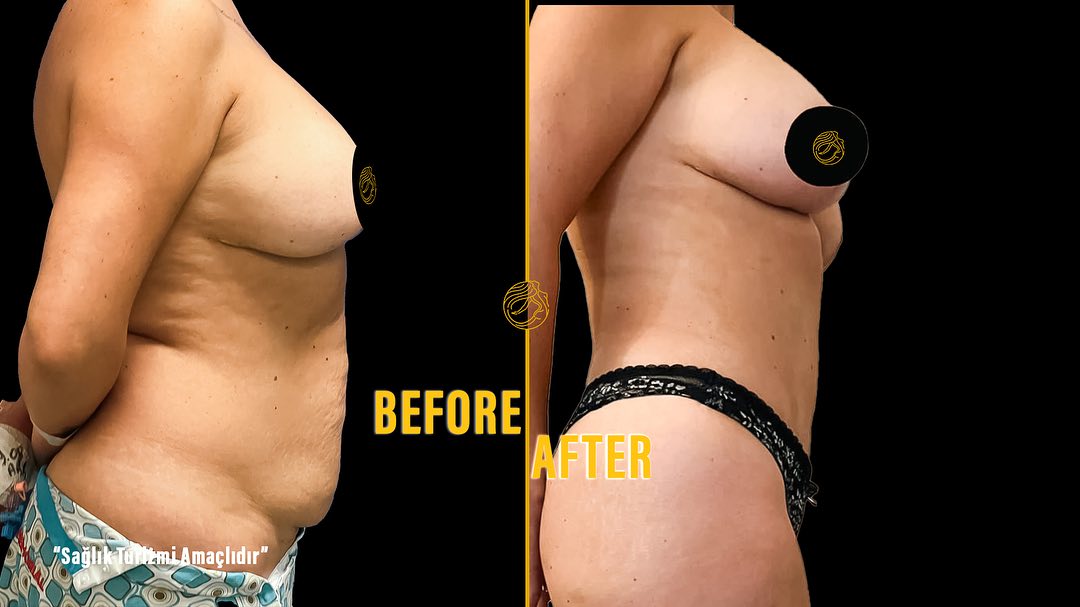 reasons-of-mommy-makeover-10