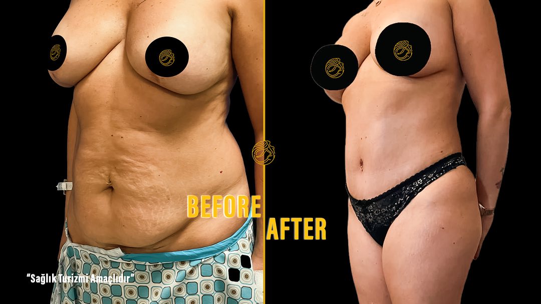 reasons-of-mommy-makeover-11