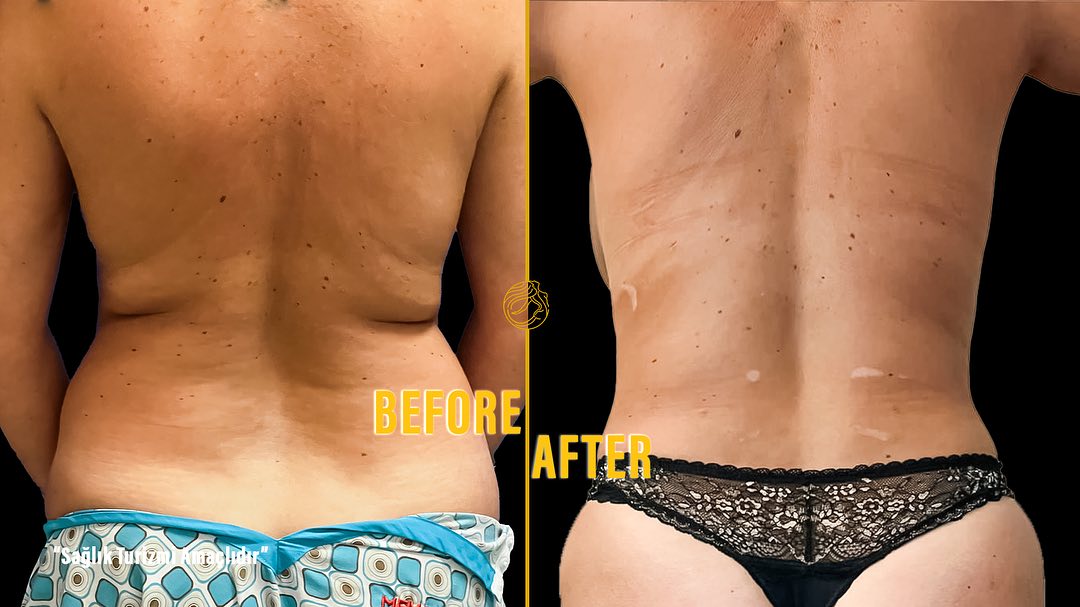 reasons-of-mommy-makeover-12