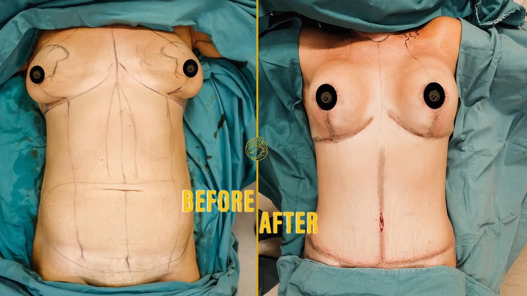 reasons-of-mommy-makeover-13