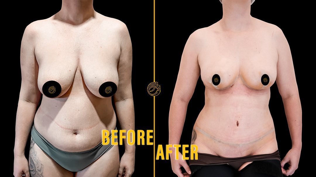 reasons-of-mommy-makeover-14