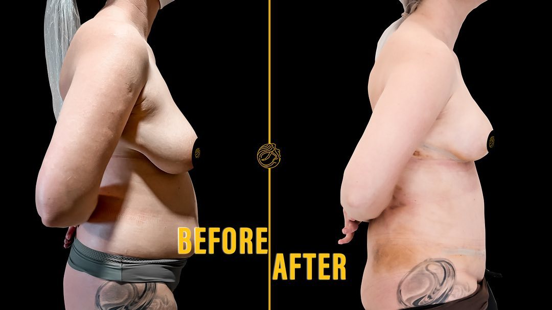 reasons-of-mommy-makeover-15