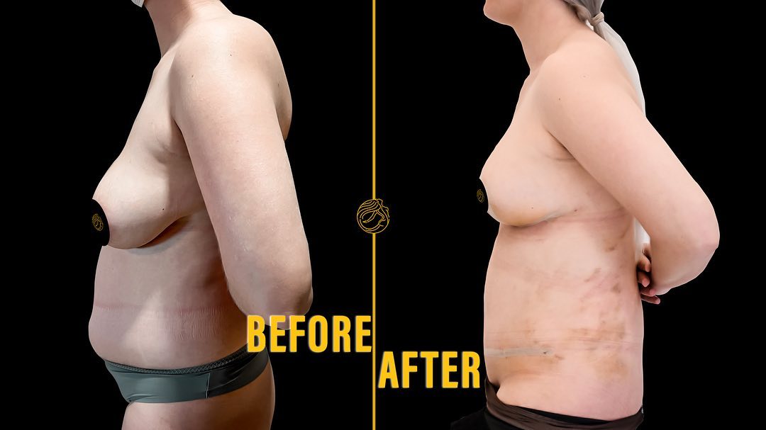 reasons-of-mommy-makeover-16