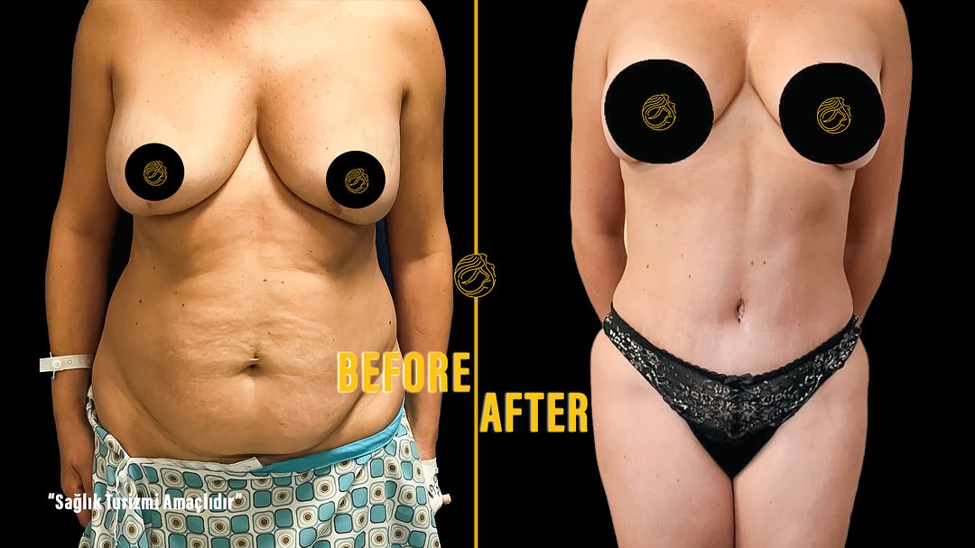 reasons-of-mommy-makeover-9