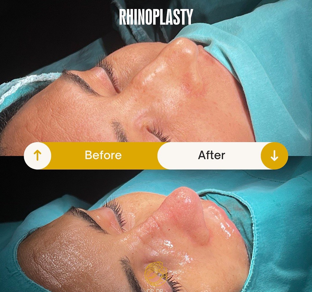 Ultrasonic Piezo Rhinoplasty before and after-2