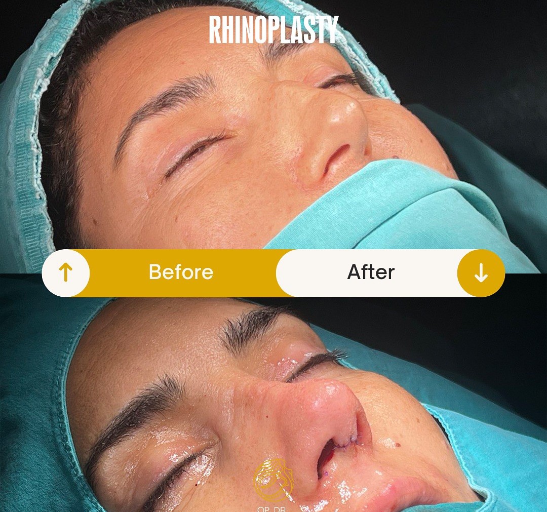 Ultrasonic Piezo Rhinoplasty before and after-3