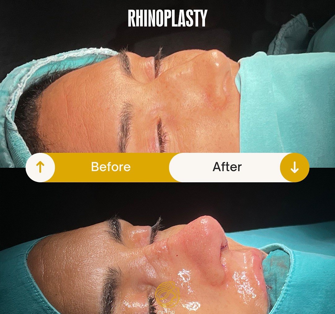 Ultrasonic Piezo Rhinoplasty before and after-4