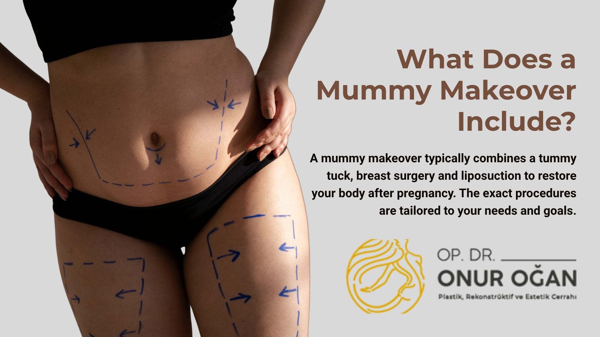 What Does a Mummy Makeover Include?