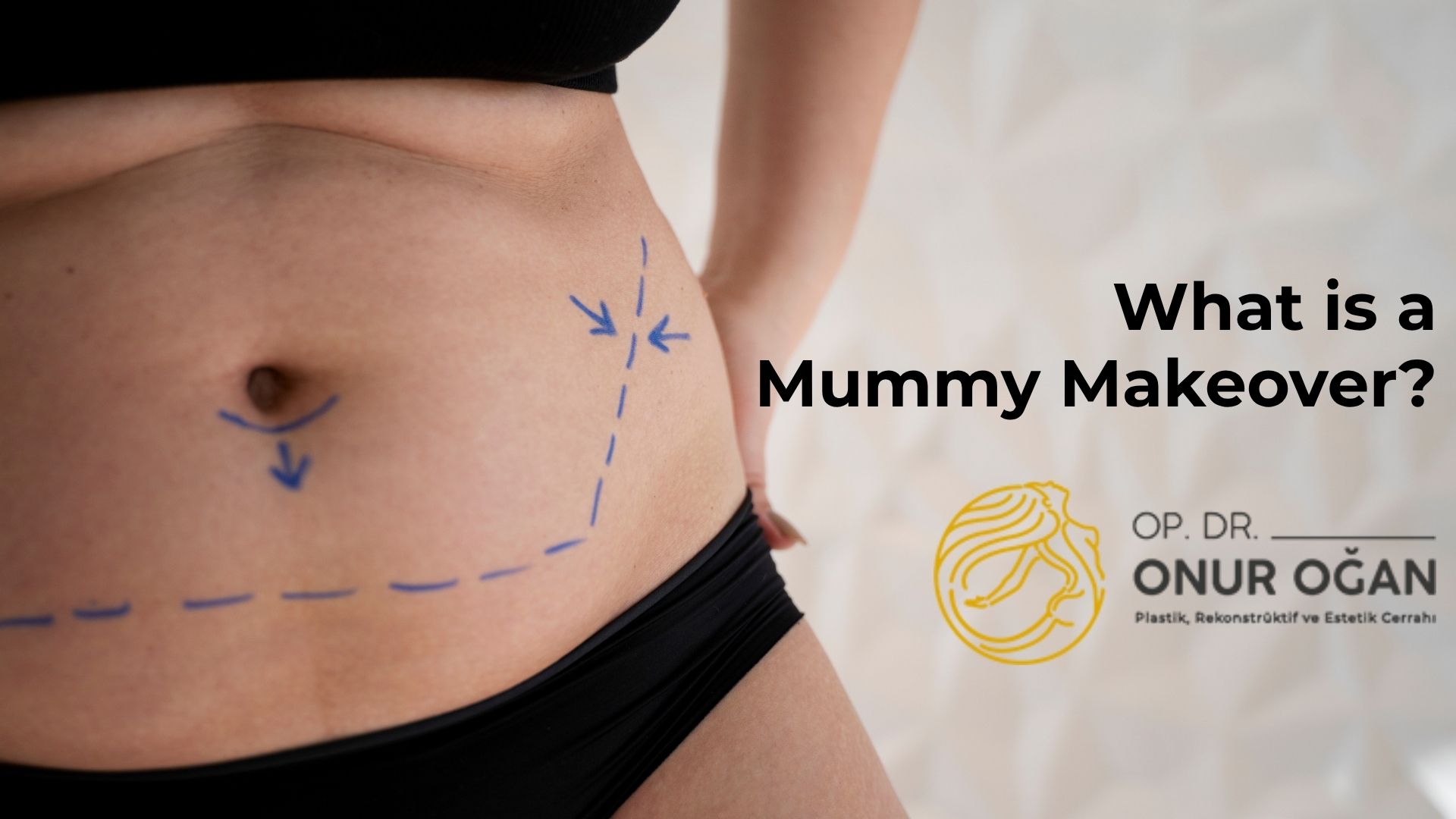 What is a Mummy Makeover?  in Turkey, Antalya